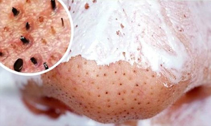 Tẩy sạch mụn đầu đen với thành phần dễ kiếm tại nhà