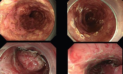Thường xuyên bị nghẹn khi nuốt thức ăn hãy cẩn thận có thể bạn đã mắc ung thư thực quản