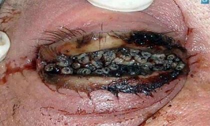 Bị ổ ký sinh trùng lúc nhúc, đục khoét trong mắt vì đeo kính áp tròng