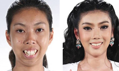 Cô gái Thái với nhan sắc 'quạ hóa công' sau thẩm mỹ