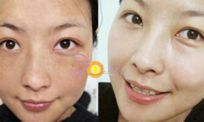 Giải pháp mới 2017 cho người da đen trở nên trắng hồng rực rỡ