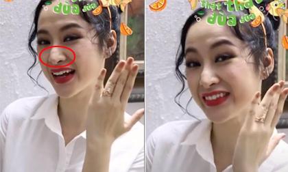 Mũi Angela Phương Trinh tiếp tục biến dạng sau khi phẫu thuật thẩm mỹ