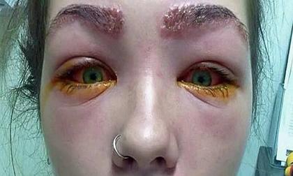 Sáng dậy thấy mắt và lông mày đầy mủ cho đến khi tả hỏa phát hiện do thuốc nhuộm