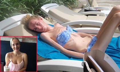 'Bộ xương khô' suýt chết vì chứng biếng ăn năm xưa giờ ra sao?