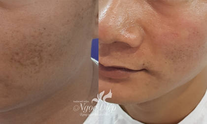 Hết sẹo không khó