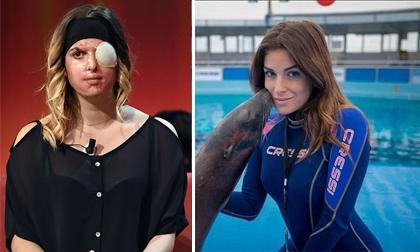 Sốc với  gương mặt bị hủy hoại của thí sinh Hoa hậu Ý do bạn trai cũ tạt axit