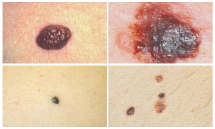 Mẹo nhìn nốt ruồi để biết ung thư da sớm nhất