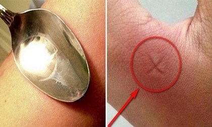 Khi bị côn trùng đốt, áp dụng ngay những thủ thuật hiệu quả bất ngờ dưới đây