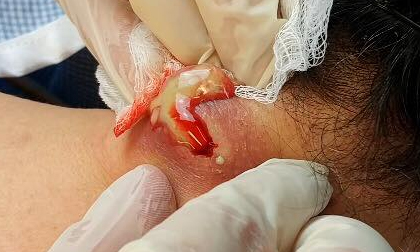 Clip nặn mụn khổng lồ thu hút hàng triệu lượt xem