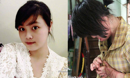 Nghị lực phi thường của cô gái 9x chỉ còn 1% cơ hội sống do bị chồng thiêu xăng