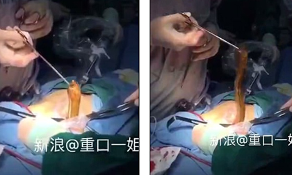 Rợn người cảnh bác sĩ lôi con lươn sống ra khỏi bụng người đàn ông