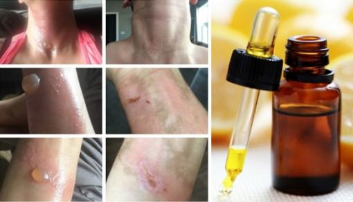 Hậu quả khôn lường của việc sử dụng tinh dầu không đúng cách
