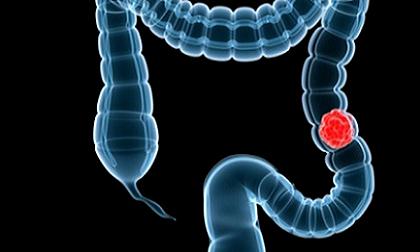 Nếu bạn sinh vào những năm này, bạn có nguy cơ mắc ung thư ruột gấp 4 lần