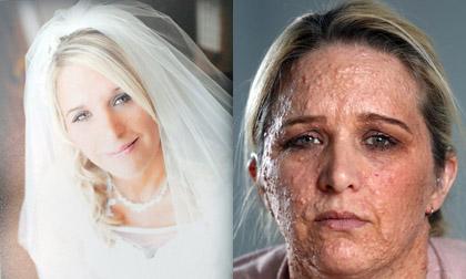 Người phụ nữ không dám ra đường vì làn da sần sùi như cá sấu