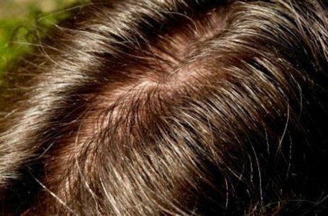 5 cách khắc phục tóc dầu phù hợp nhất