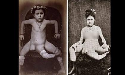 Sốc với cô gái có 3 chân, 4 ngực và 2 âm đạo