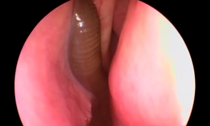 Clip gắp đỉa dài 8cm sống trong mũi bệnh nhân nhiều tháng liền