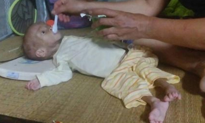 Nước mắt người mẹ có con mắc bệnh ngày càng teo đét, 4 tuổi nặng 3,6kg