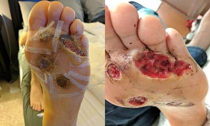 Nhiễm vi khuẩn ăn thịt vì thói quen đi tắm mà không mang dép