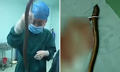 Kinh hoàng người đàn ông cho lươn dài 0,5m vào hậu môn và cái kết 'thốn ruột'