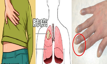 Những dấu hiệu ung thư phổi tuyệt đối không được bỏ qua