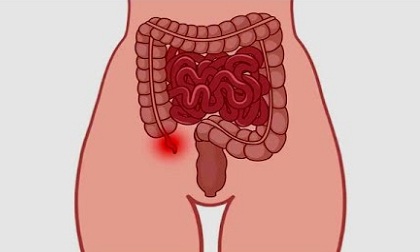 5 dấu hiệu của một người sắp bị vỡ ruột thừa