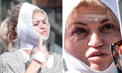 Nữ diễn viên Anh gây sốc với gương mặt băng bó sau khi 'sửa chữa' vì thẩm mỹ hỏng