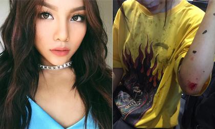 Quán quân The Voice - Vũ Thảo My bị ngã vì gặp ô tô chạy ẩu