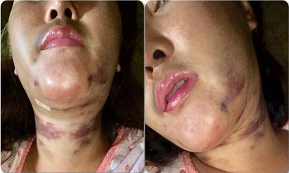 Khuôn mặt kinh dị của cô gái sau khi hút mỡ làm đẹp