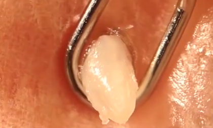 Cận cảnh pha nặn mụn trứng cá to hơn hạt gạo hút hơn 6 triệu lượt xem