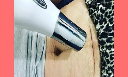 Dùng máy sấy tóc thổi vào vết mổ đẻ sau sinh, người phụ nữ nhận về công dụng không ngờ