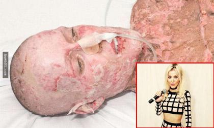 Sự trở lại đáng kinh ngạc của cô gái xinh đẹp bị tạt axit khiến mọi người khâm phục