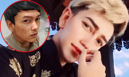 Shock với khuôn mặt nổi đầy mụn của chàng hot boy đình đám trước thẩm mỹ
