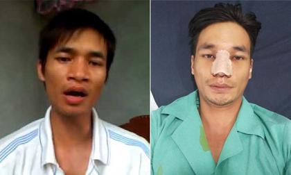 Hết Tùng Sơn lại tới Lệ Rơi bất ngờ lộ hình ảnh sau ca phẫu thuật thẩm mỹ