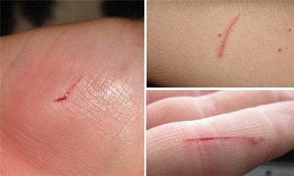 Cảnh báo: Đừng chủ quan với những vết xước nhỏ vì nó có thể khiến bạn tử vong