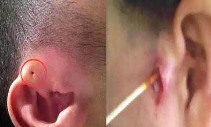 Thấy lỗ nhỏ ở vành tai tưởng con thông minh ai ngờ cực nguy hiểm