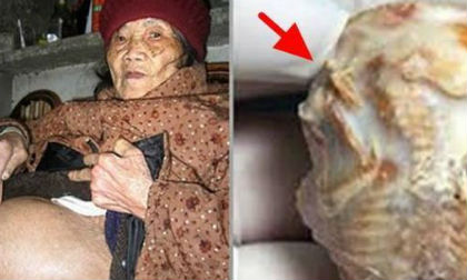 Bà lão 92 tuổi phát hiện đứa con 50 năm vẫn trong bụng mình