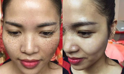 Chi phí trị nám, đến cả người thu nhập bình quân cũng có thể