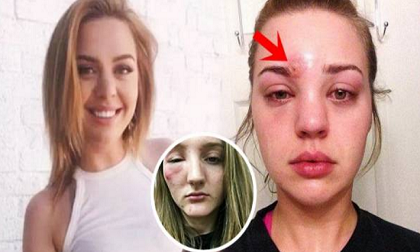 Thiếu nữ bị biến dạng mặt do nặn mụn, lời cảnh báo cho mọi cô gái