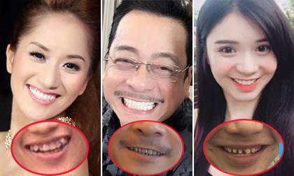 Chẳng cần 'dao kéo' hay make -up, loạt sao Việt 'một bước lên tiên' nhờ chỉnh răng