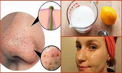 Da chết và mụn đầu đen cứ thế chui ra ầm ầm mà không cần nặn nhờ công thức sau