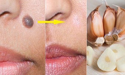 Lấy một nhánh tỏi khô làm theo cách sau, cần gì tốn bạc triệu đi spa tẩy nốt ruồi