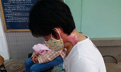 Cô gái bị chồng tẩm xăng đốt: 'Không dám gặp con vì sợ con hoảng loạn khi nhìn thấy mẹ'