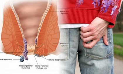 Cẩn thận nếu thấy hậu môn bị ngứa, nó là dấu hiệu của nhiều bệnh cực nguy hiểm