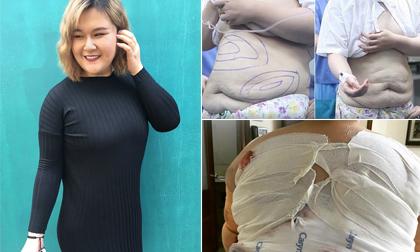 Diễn viên Ngô Thủy Tiên thon gọn nhiều sau khi cắt bỏ 4kg mỡ bụng và hút mỡ toàn thân 