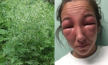 Loại cỏ dại mọc khắp nơi ở Việt Nam này có thể gây ra dị ứng khủng khiếp
