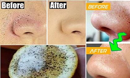 Không cần nặn đau đớn, mụn đầu đen sẽ từ từ chui ra nếu bạn làm theo cách sau