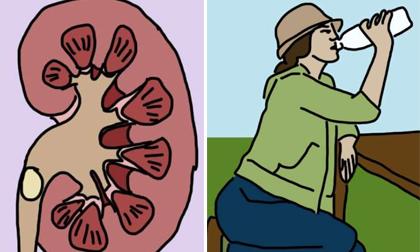 Điều trị sỏi thận mà không cần gặp bác sĩ từ những thứ trong nhà