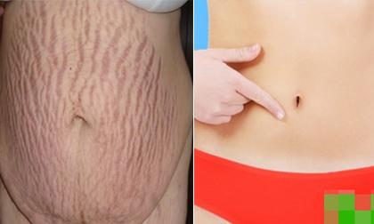 7 cách làm mờ vết rạn da sau sinh các chị em nên biết