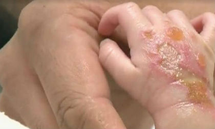 Cẩn thận khi truyền dịch cho trẻ - sai lầm sẽ gây hậu quả khôn lường